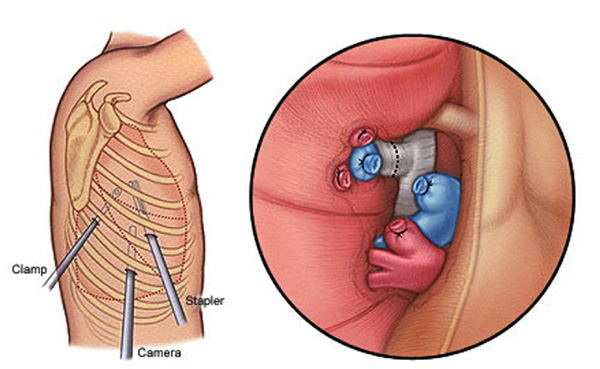 How Long To Recover From Lung Lobectomy