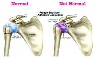 Frozen shoulder - Jammu Kashmir Latest News | Tourism | Breaking News J&K